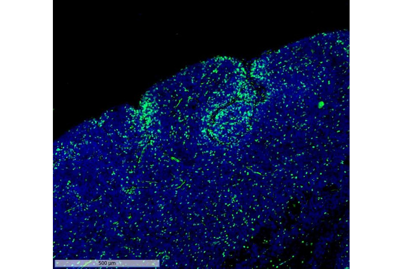 In a mouse model of medulloblastoma, OLIG2+ stem cells are immunostained green, with all nuclei labeled blue (DAPI). These OLIG2+ cells divide slowly to renew their population and to generate rapidly proliferative daughter cells that contribute to the bulk of the tumor. We hypothesized that OLIG2 not only marks the identity of these cells but also controls their tumorigenesis, and that inhibiting OLIG2 would reduce their tendency to generate active tumor cells.Created with BioRender.com. Image Credit: Emory University