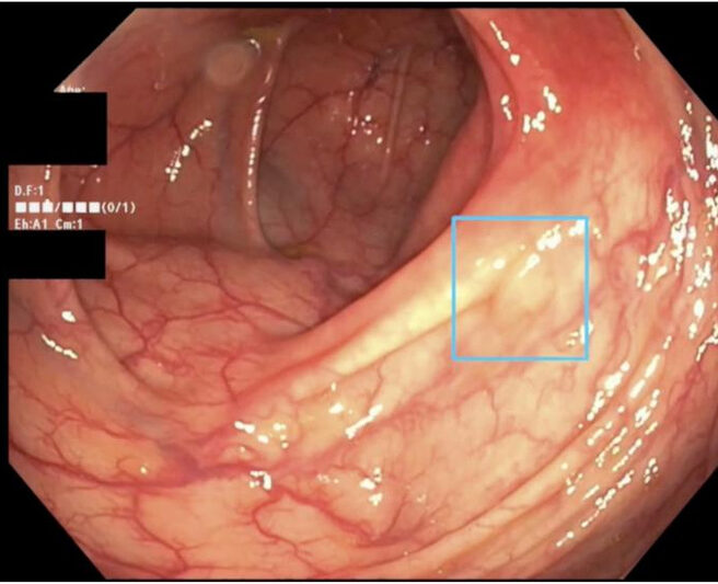 A computer-aided detection (CADe) device spots a 4-mm adenoma in the hepatic flexure. Image Credit: Gastroenterology