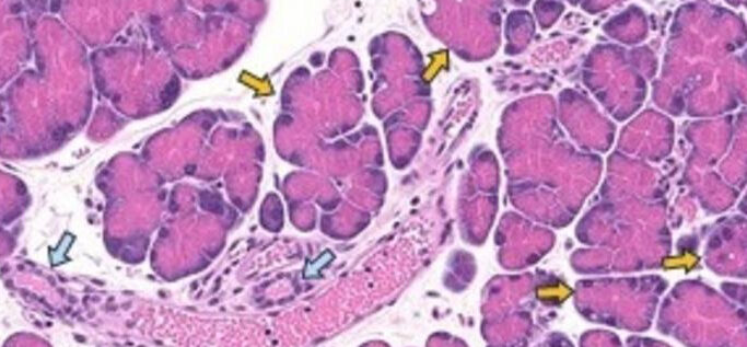 Blue arrows point to normal pancreatic ductal mouse cells. Yellow arrows point to cells undergoing acinar-to-ductal metaplasia. Credit: Johns Hopkins Medicine
