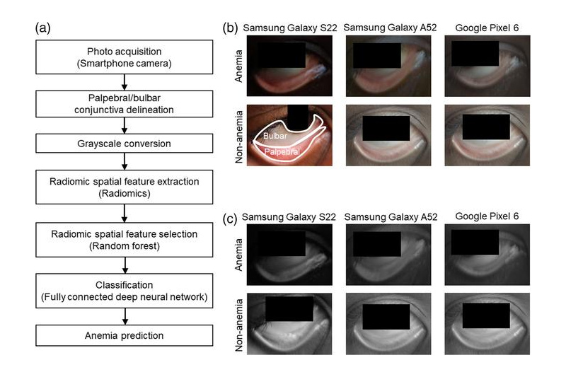 mHealth radionomic analysis of grayscale photos of the eye’s conjunctiva help predict anemia prediction in school-age children. Each analysis focuses on extracting predefined mathematical characterizations of spatial and textural patterns associated with anemia. Credit: S. S. Hong et al., 10.1117/1.BIOS.2.2.022303.